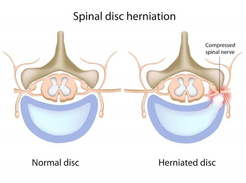 Diagrama comparando um disco normal e um disco herniado em corte transversal, com destaque para a raiz nervosa comprimida pelo disco deslocado