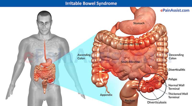 o que e sindrome do intestino irritavel e como acupuntura ajuda