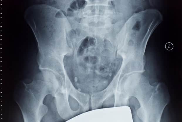 Radiografia frontal da pelve mostrando sacro, ossos ilíacos e as duas articulações sacroilíacas.