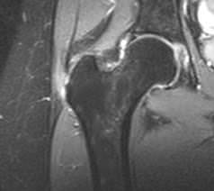 ressonancia com inflamacao da bursite trocanterica