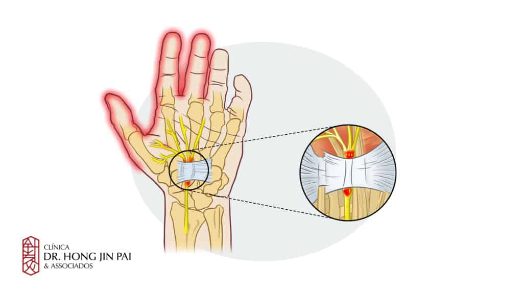 sindrome do tunel do carpo - dor nos dedos das maos