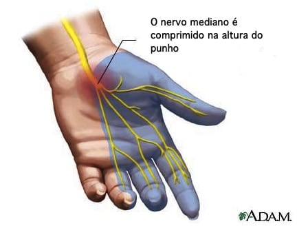 tunel do carpo e nervo comprimido