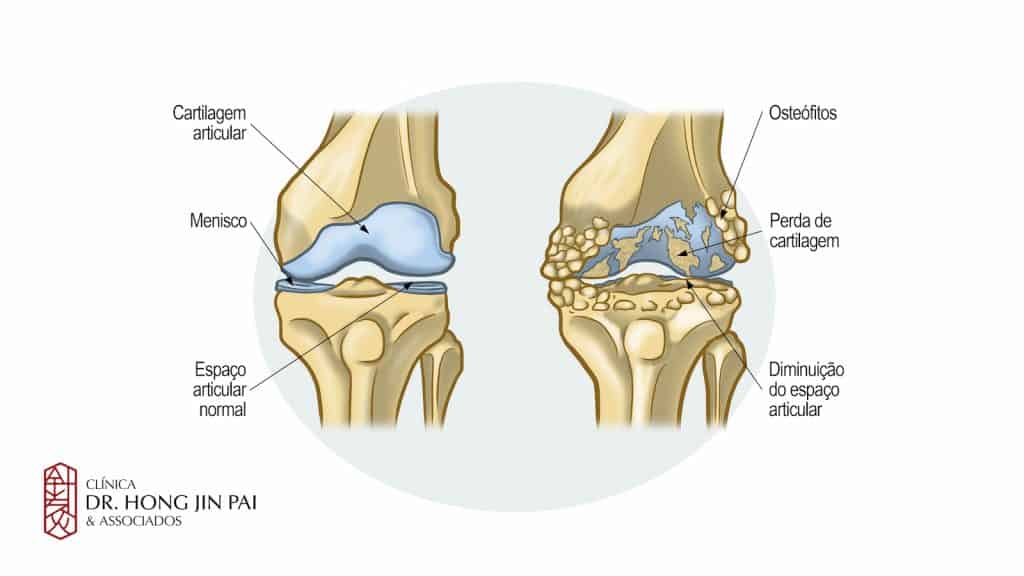 Joelho saudável e joelho com artrose lado a lado, com rótulos para cartilagem articular, menisco, espaço articular, osteófitos e perda de cartilagem.