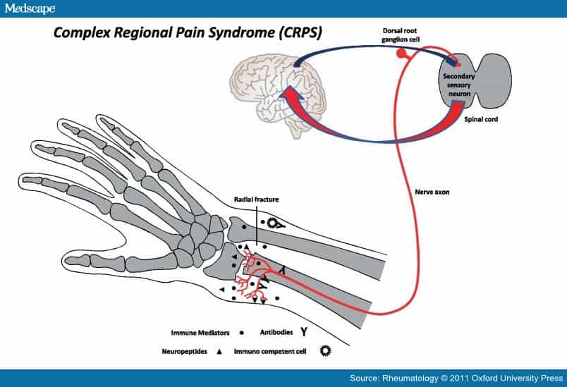 aprenda mais sindrome complexa de dor regional