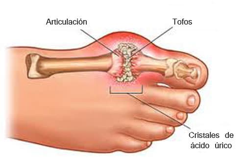 gota cristais de acido urico