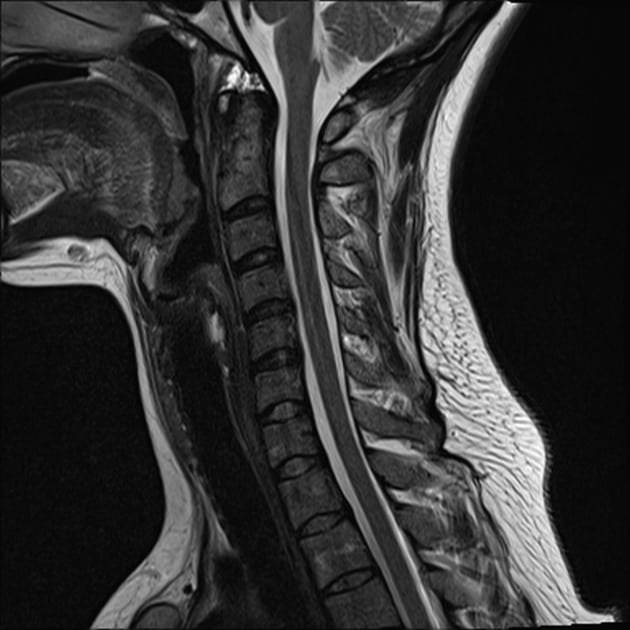 ressonancia magnetica cervical normal