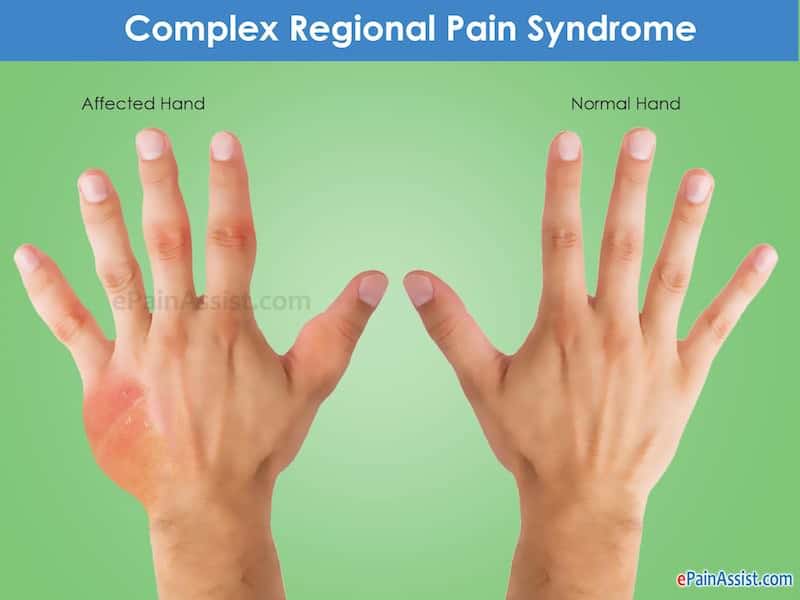 sindrome complexa de dor regional o que e