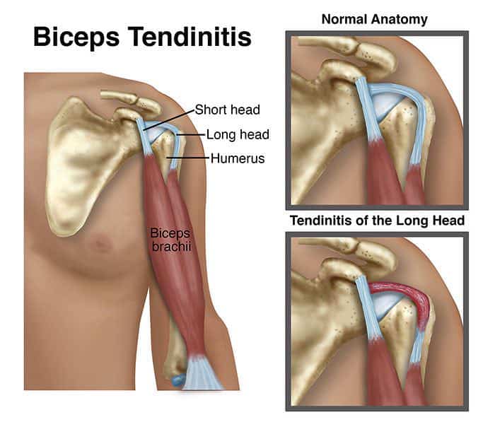 Ilustração anatômica do ombro mostrando o tendão do bíceps com cabeça curta e cabeça longa, comparando anatomia normal e tendinite da cabeça longa