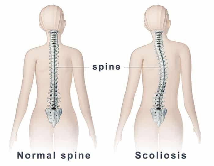 Ilustração comparando duas figuras femininas vistas de costas: a esquerda coluna reta e centralizada, a direita coluna com desvio lateral em forma de S, ambas rotuladas spine.
