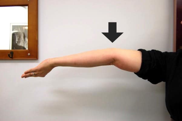 Braço estendido na horizontal com o cotovelo curvado para trás além da linha reta, indicado por uma seta preta apontando para a articulação hiperestendida.
