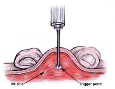 Ilustração de uma agulha penetrando a pele até atingir um ponto-gatilho dentro do musculo, com os rótulos musculo e ponto-gatilho.