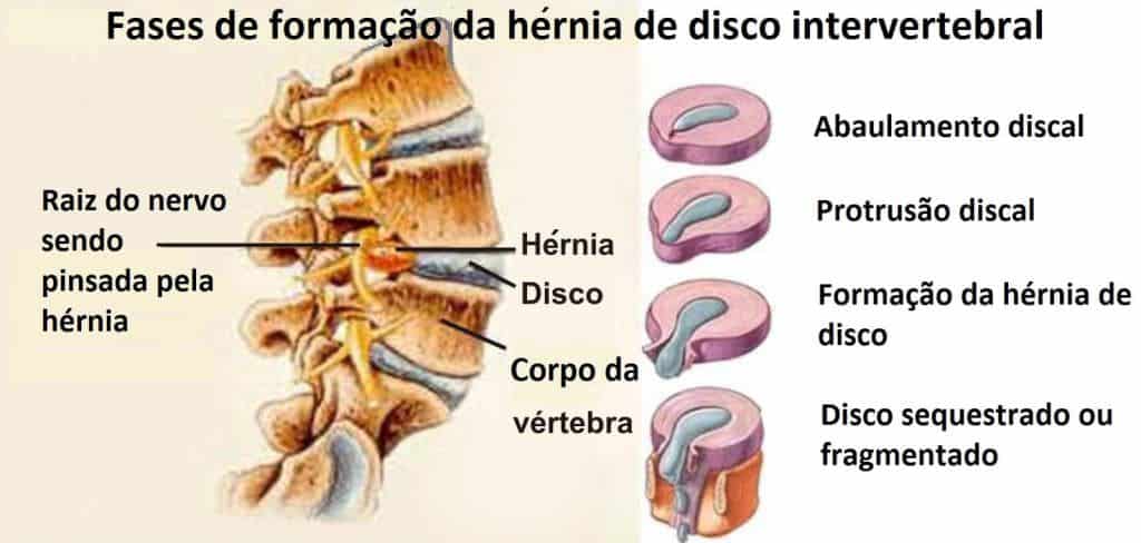 Diagrama anatômico em português das fases de formação da hernia de disco: abaulamento, protrusão, formação da hernia e disco sequestrado ou fragmentado, com a raiz nervosa pinçada.