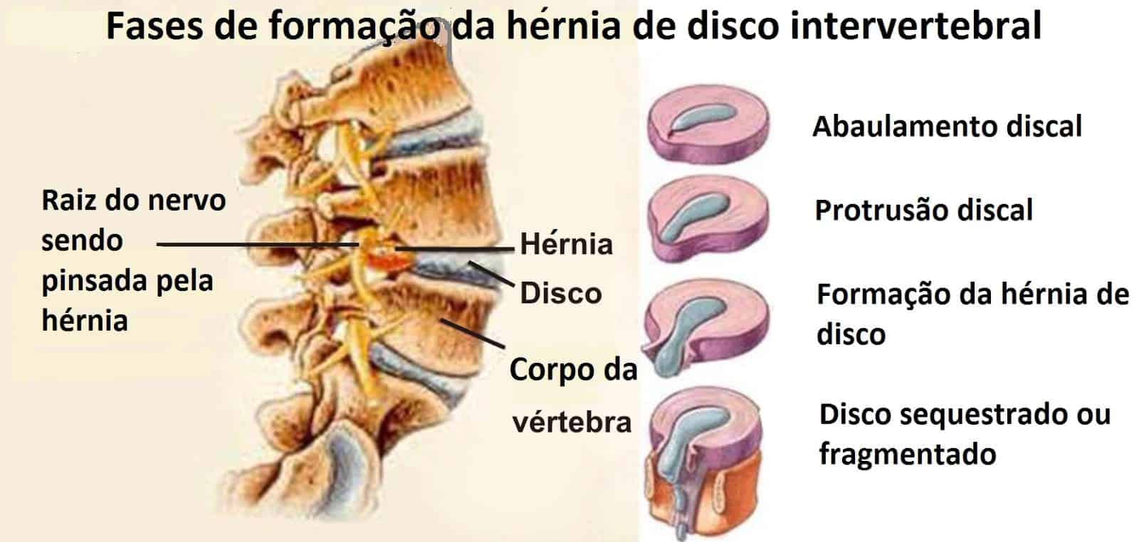 protrusão