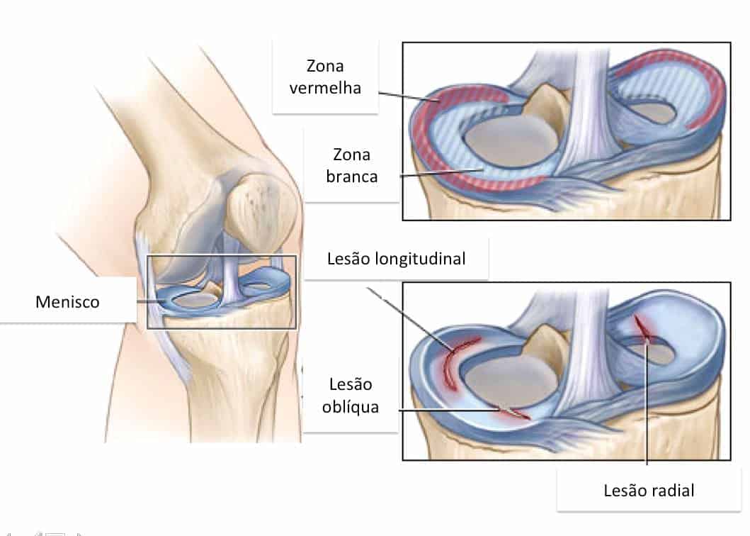 sintomas lesion menisco externo