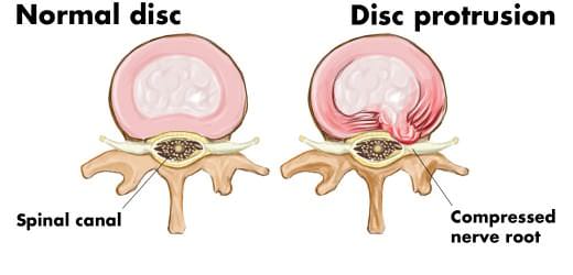 protrusao de disco