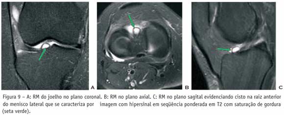 Três imagens de ressonância magnética do joelho nos planos coronal, axial e sagital com setas verdes apontando a lesão do menisco