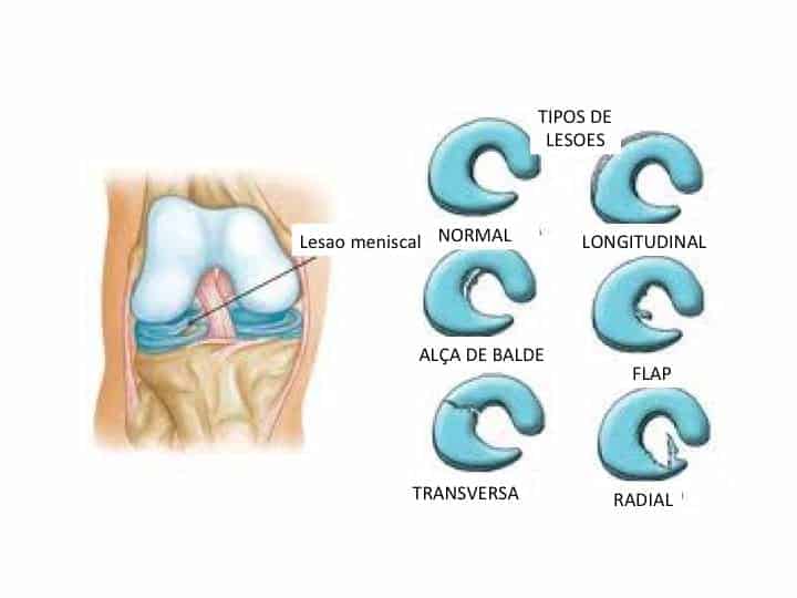 Melhor maneira de curar ciática