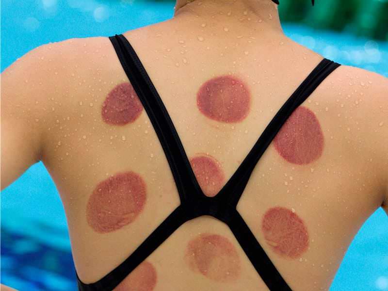 Costas de uma nadadora mostrando várias marcas circulares avermelhadas deixadas pela aplicação das ventosas.
