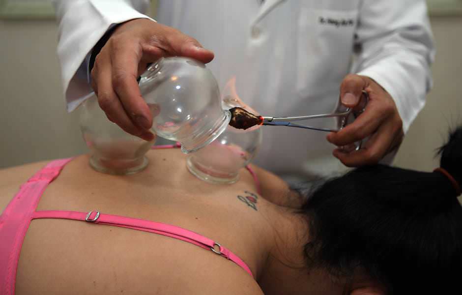 Terapeuta de jaleco branco aquece o interior de um copo de vidro com uma chama em pinça antes de aplica-lo nas costas da paciente.