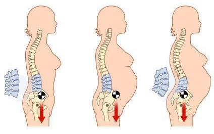 alteracoes-biomecanicas-coluna-gravidez