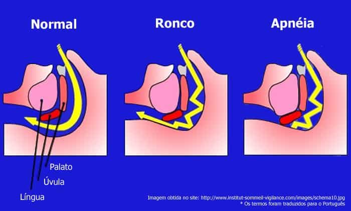 apneia-do-sono-dor-cronica