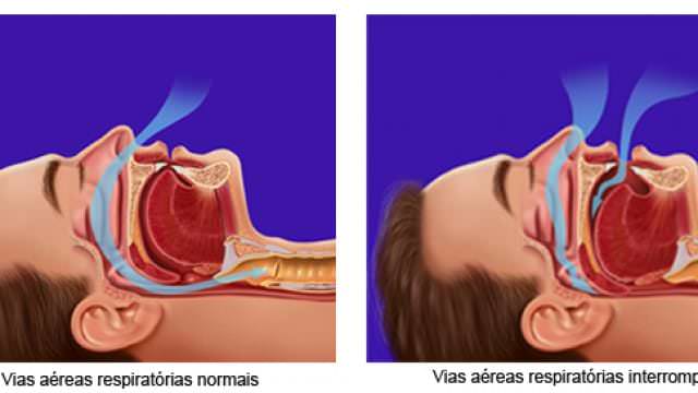 apneia-do-sono-e-dor