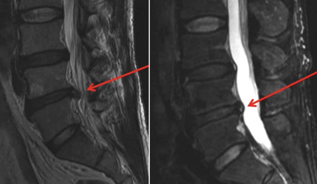 Duas ressonâncias magneticas sagitais da coluna lombar com setas vermelhas apontando para a hernia que comprime o canal vertebral
