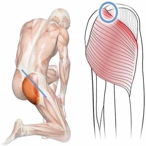 trigger point ponto gatilho ondas de choque