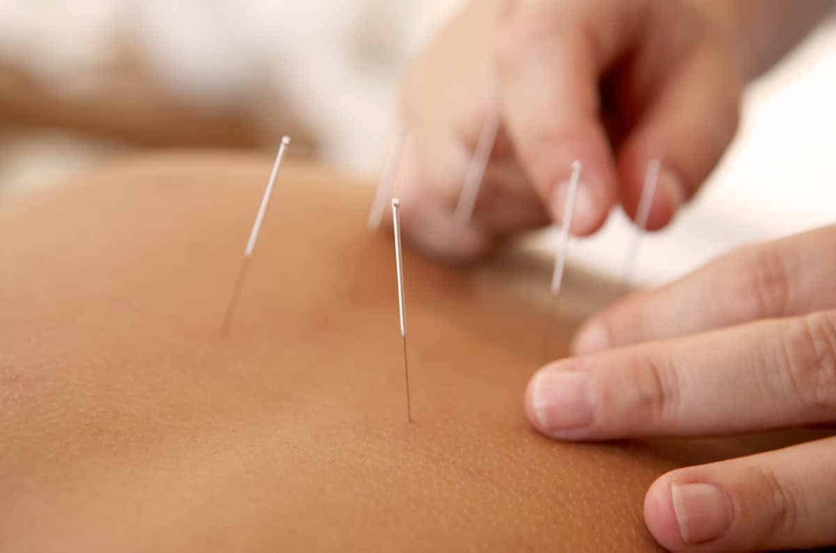 analgesia-acupuntura