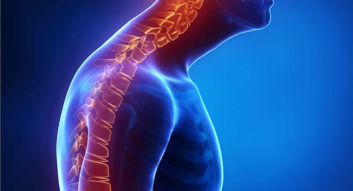 Cifose O que é, causas, sintomas e tratamentos Clínica Dr. Hong Jin Pai Dor e Acupuntura Médica