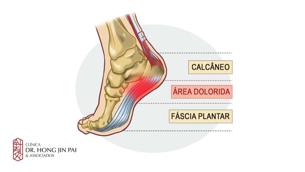 Fascite plantar dor na sola dos pes