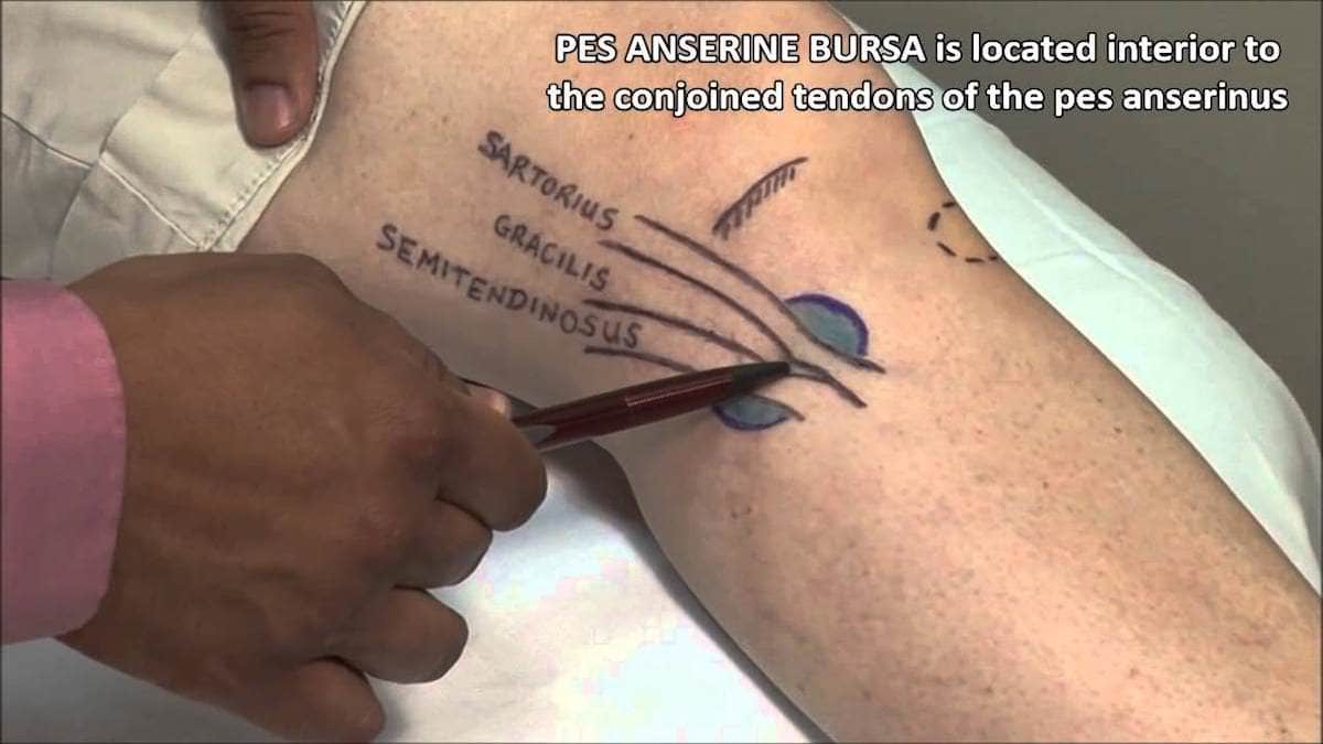 localizacao-bursite-anserina