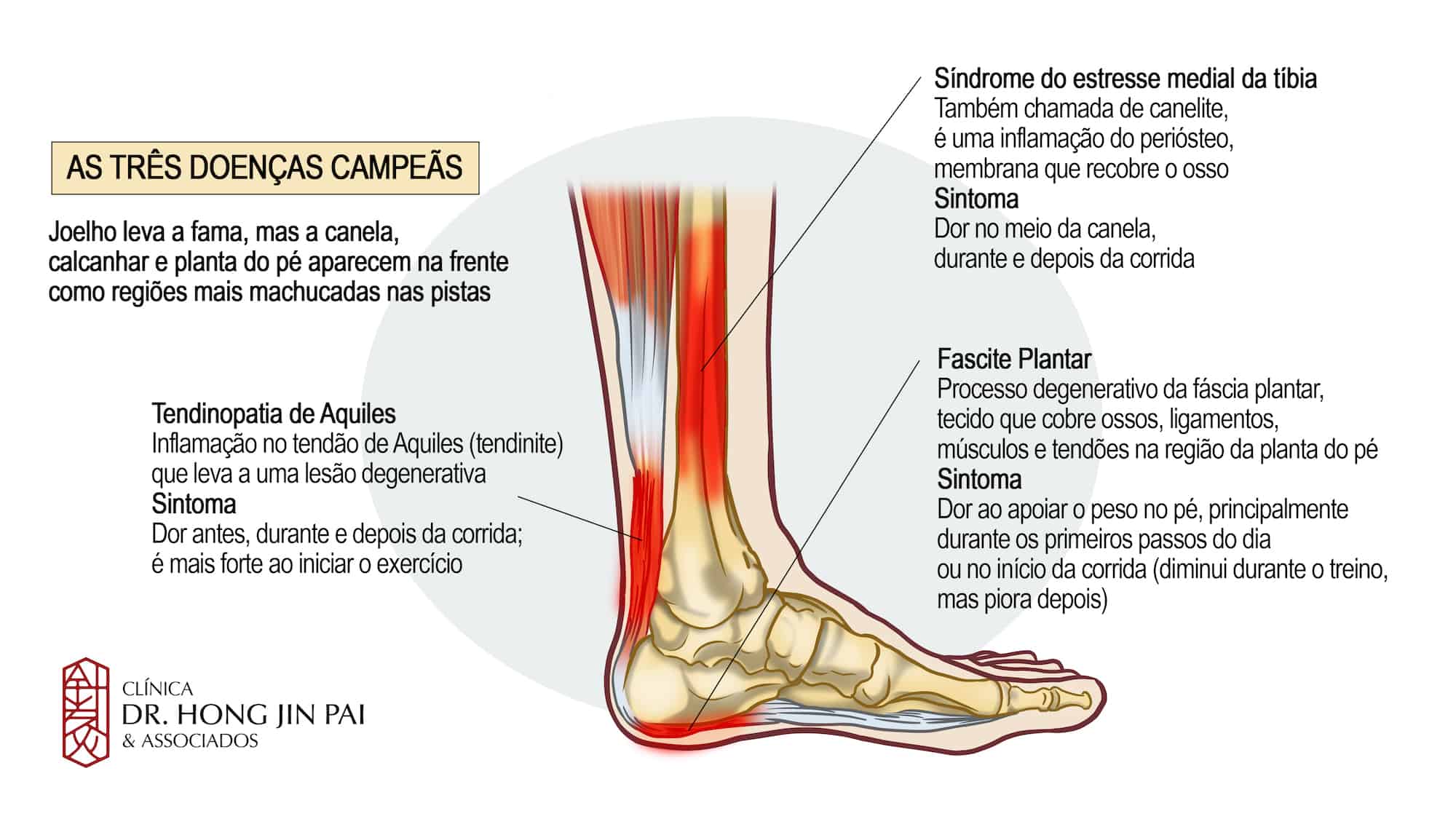 Causas comuns de dor nas pernas e pés