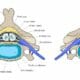 Protrusão discal: sintomas e tratamento