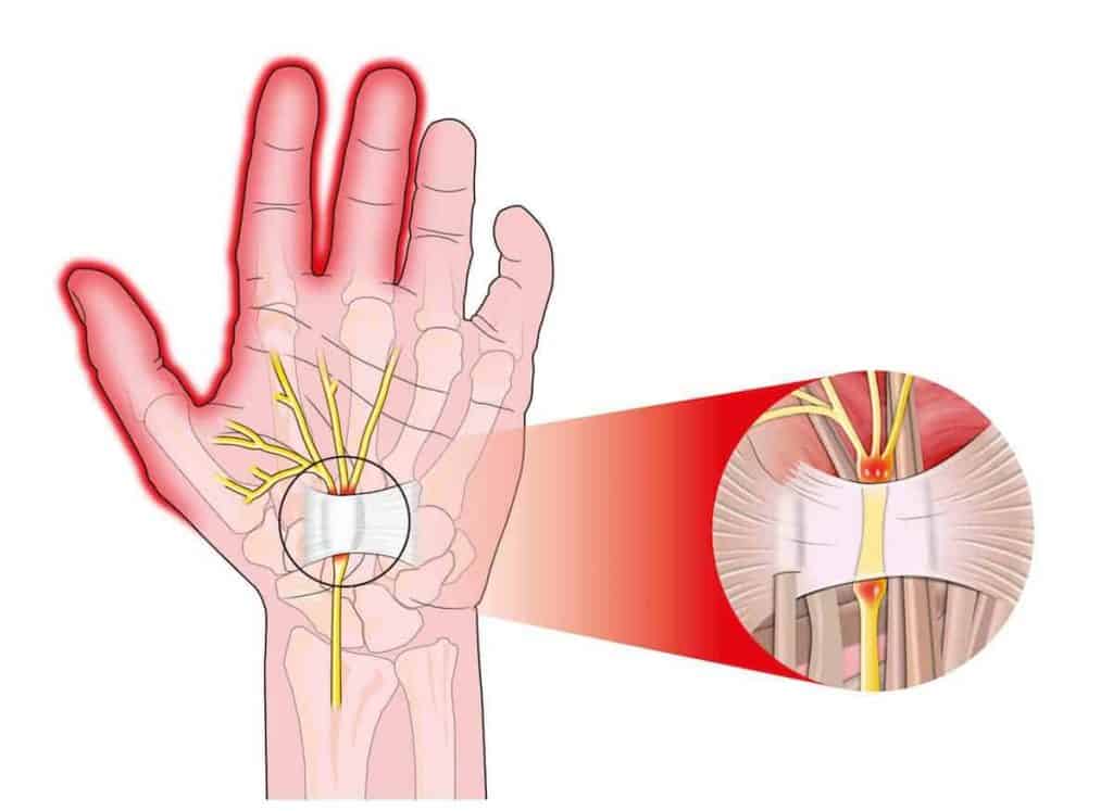 sindrome-tunel-do-carpo