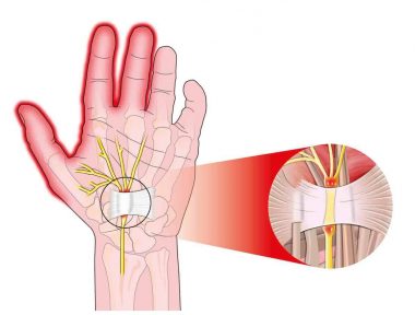 sindrome-tunel-do-carpo