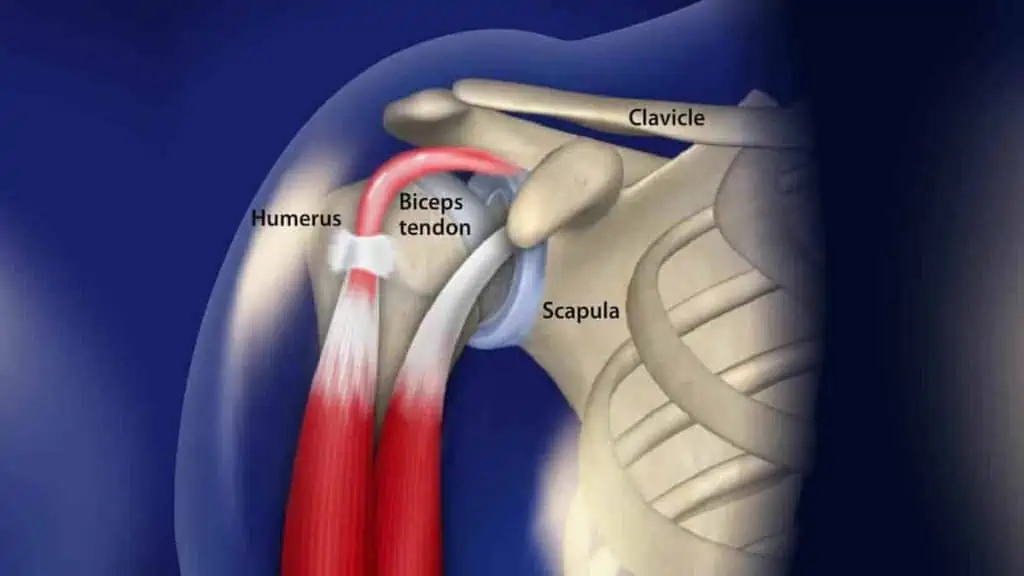 tendinopatia-biceps-dor-no-ombro