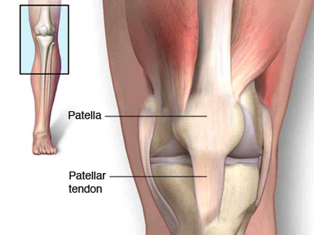 Ilustração anatômica do joelho mostrando a patela e o tendão patelar conectando a patela a tíbia, com vista ampliada da articulação.