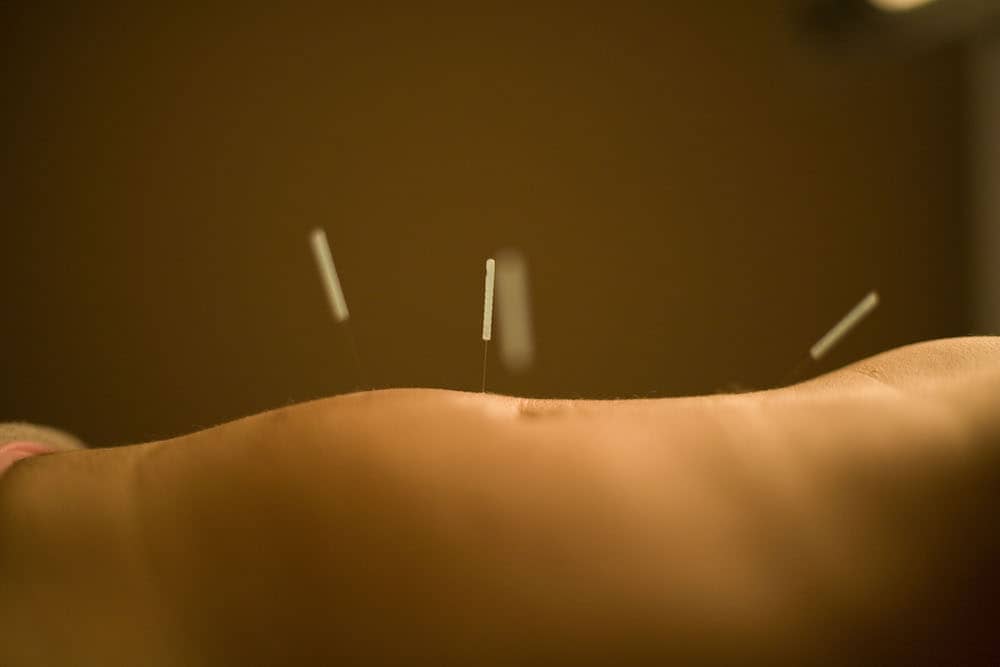 acupuntura dor abdominal hong jin ai