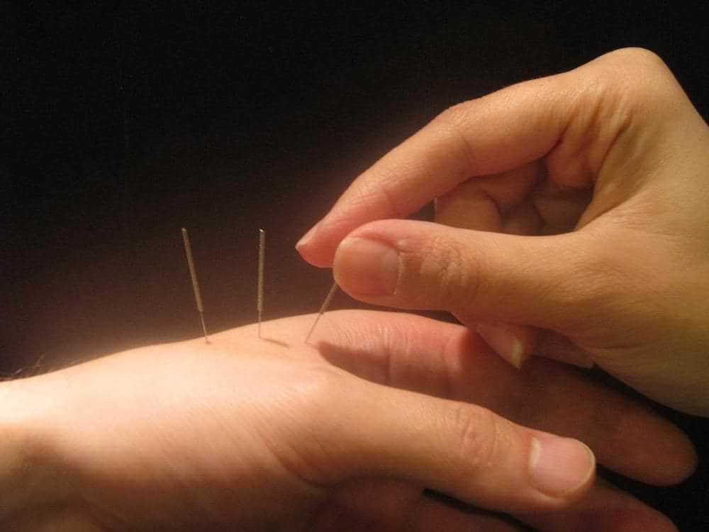 acupuntura dor tratamento
