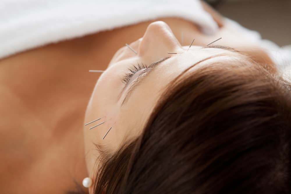 Agulhas finas de acupuntura inseridas na testa e ao redor do olho de uma paciente deitada e relaxada.