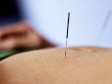 Agulha fina de acupuntura inserida na pele.