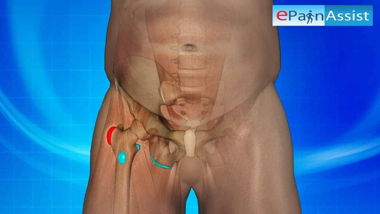 bursite quadril