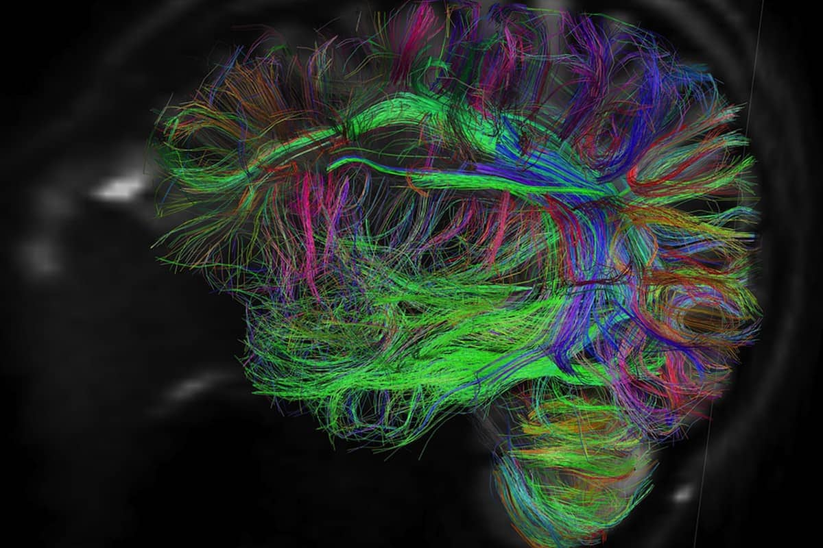 cerebro fibromialgia dor