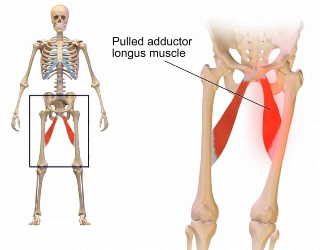 Dor nos adutores: pubalgia, distensão e tratamento 4 Ilustração de esqueleto com destaque em vermelho do músculo adutor longo na coxa interna, indicando lesão por estiramento.
