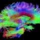 Estudo identifica os tipos de disfunção cognitiva mais prevalentes na fibromialgia