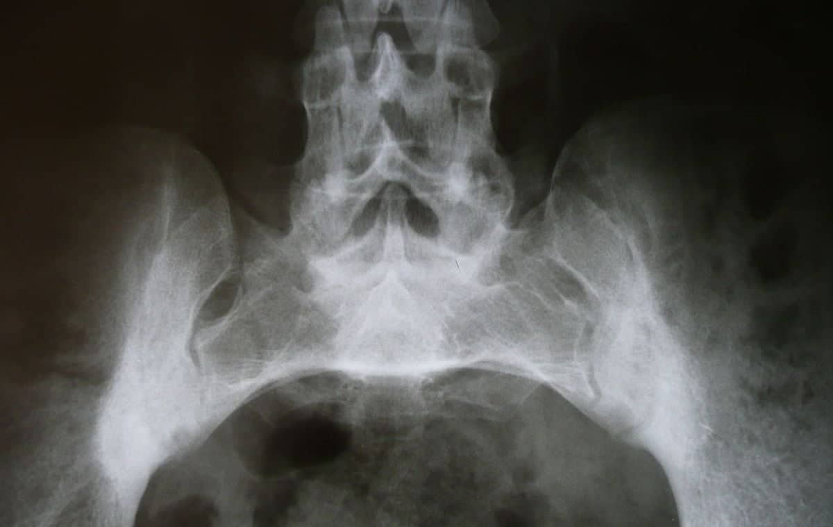 diagnostico sacroileite