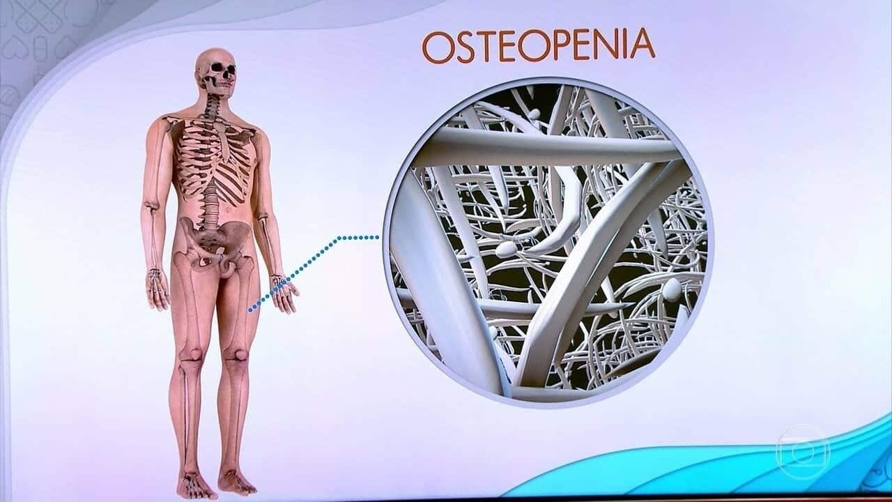 Osteopenia