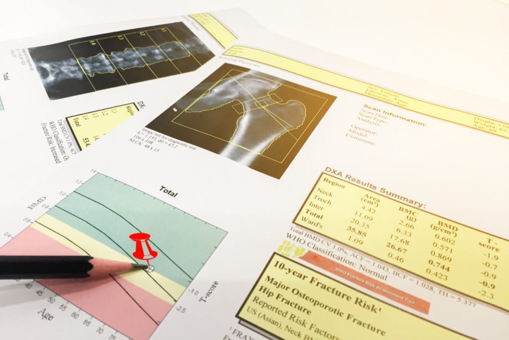 Laudo de densitometria óssea (DXA) com imagens da coluna e do fêmur, gráfico de T-score por idade e tabela de resultados de densidade mineral óssea.