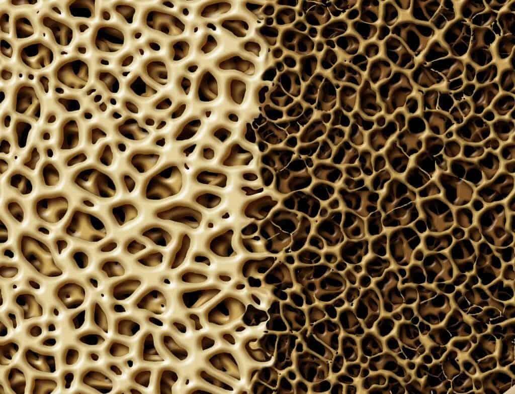Comparação lado a lado da microestrutura óssea: à esquerda trabéculas espessas e densas, à direita trabéculas finas e cheias de espaços.